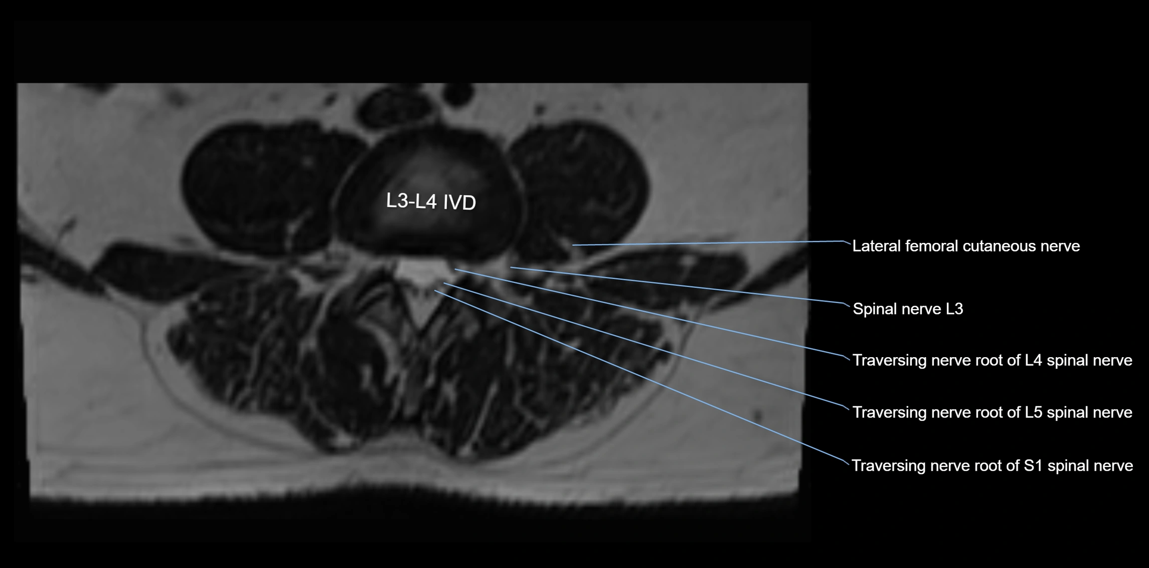MR lumbosacral plexus axial cross sectional anatomy 3T  radiology  image-img-1008001-00032.webp